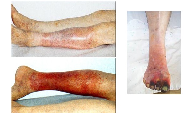 Атеросклероз на ногах