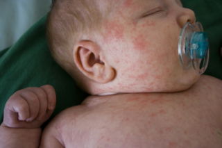 Аллергия на молоко у ребенка
