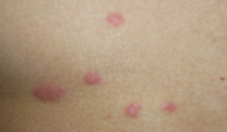 Сыпь в виде комариных укусов