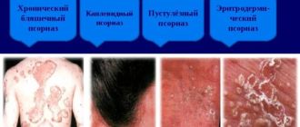 Типы Псориаза