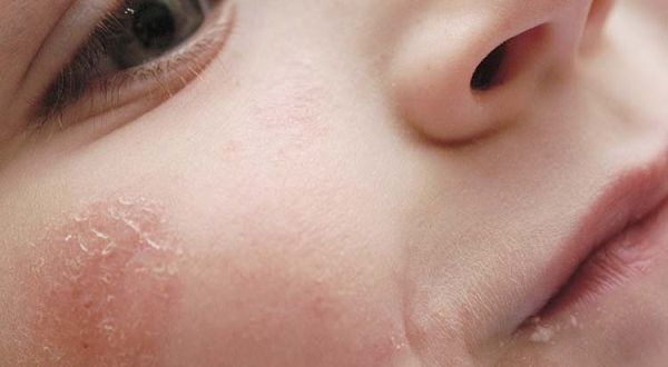 Контактный дерматит у детей