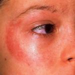 Аллергия на солнце около глаза