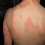 Аллергия на прививку от столбняка