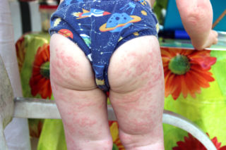 Аллергия на порошок у ребенка