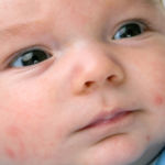 Аллергия на лице новорожденного прыщики
