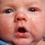 Аллергия на лице новорожденного сыпь