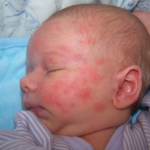 Аллергия на лице новорожденного красные пятна