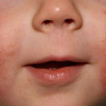 Аллергия на щеках новорожденного