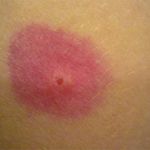 Аллергия на укус блохи на коже ребенка