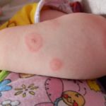 Аллергия на укус комара на руке ребенка