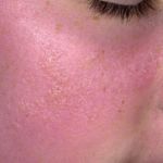 Аллергия на солнце на лице