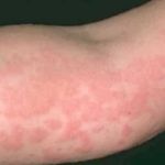 Аллергия на солнце на руке