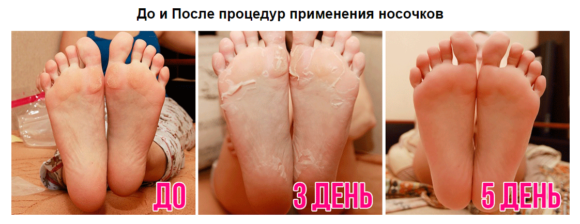 До и после применения носков