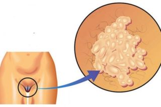 Папиллома у женщины