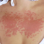 Аллергия на солнце на груди