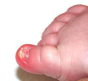 Грибок ногтей у ребенка с осложнением