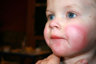 Холодовая аллергия у ребенка