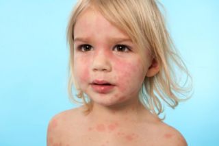 Аллергический дерматит у девочки