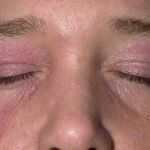 Хронический аллергический дерматит на лице