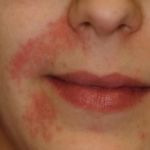 Пищевой аллергический дерматит  на лице