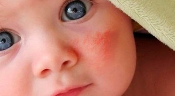 Аллергический дерматит у ребенка на щеке