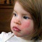 Холодовая аллергия у ребенка