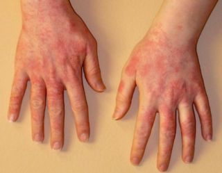 Аллергия на холод на руках
