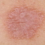 Атопический аллергический дерматит на коже