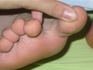 Шелушение между пальцев ног