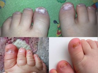 грибок ногтей на ногах у детей