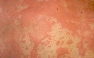 Аллергия на холод на коже