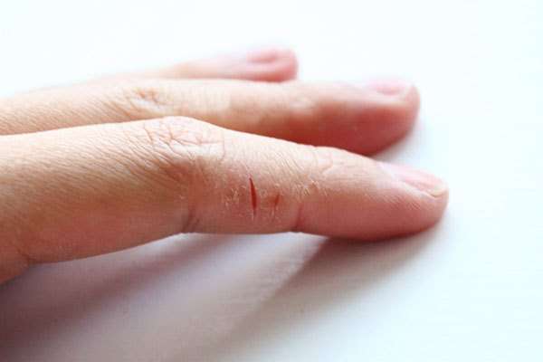 Трещины между пальцев рук
