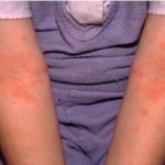 Атопический дерматит у ребенка на локтях