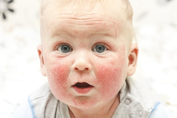 Атопический дерматит у детей – симптомы, лечение, диета, причины