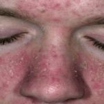 Атопический дерматит у взрослого на лице