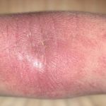 Атопический дерматит у взрослого на руке