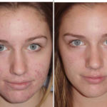Фото до и после применения Левомеколя на лице