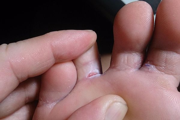 Слезает кожа между пальцев ног при беременности thumbnail