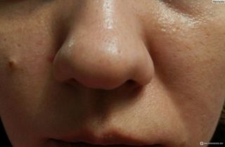 Первые признаки демодекса на лице