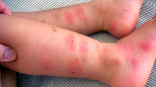 Укусы комаров на ногах детей