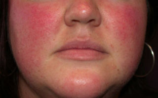 Аллергия на лице у девушки