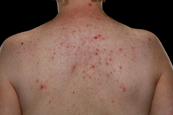 Угревая сыпь на спине у мужчин лечение в домашних условиях фото thumbnail