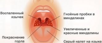 Симптомы герпесной ангины у взрослых