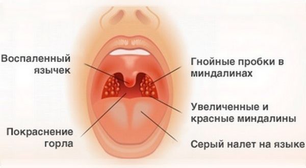 Симптомы герпесной ангины у взрослых