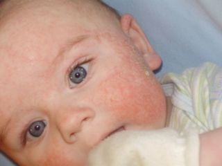 Аллергия на лице новорожденного