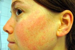 Чем убрать аллергию на лице. Почему возникает и как проявляется аллергия на лице. Аллергические реакции у грудничков