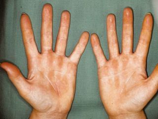 Контактный дерматит на руках