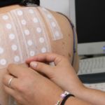 Аппликационные кожные тесты на аллергию