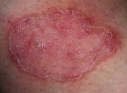 Грибковые заболевания кожи