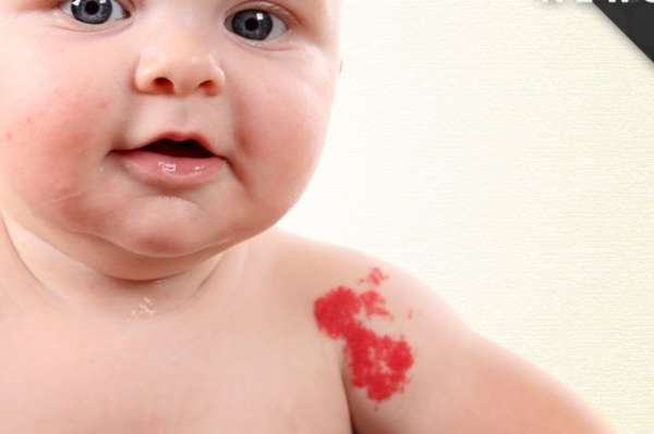 Пятна на лице красные пятна чем лечить фото у ребенка
